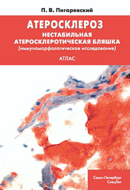 Атеросклероз. Нестабильная атеросклеротическая бляшка (иммуноморфологическое исследование) - П. В. Пигаревский