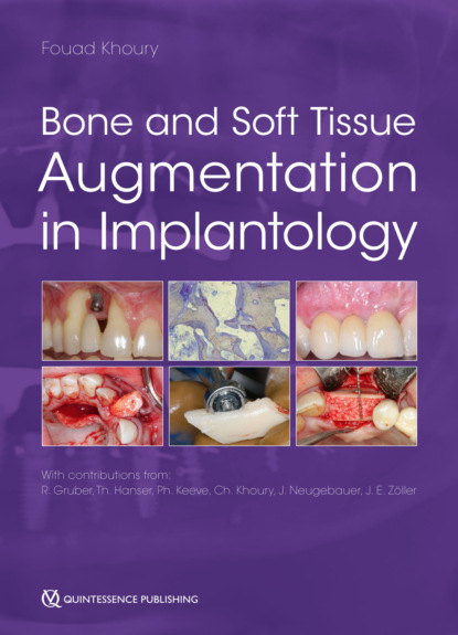 Bone and Soft Tissue Augmentation in Implantology — Группа авторов