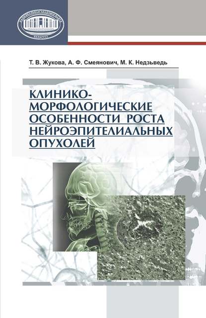 Клинико-морфологические особенности роста нейроэпителиальных опухолей - Т. В. Жукова