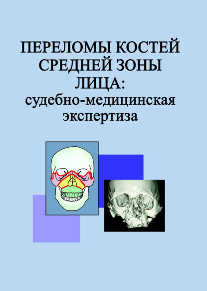 Переломы костей средней зоны лица: судебно-медицинская экспертиза — Л. Н. Гришенкова