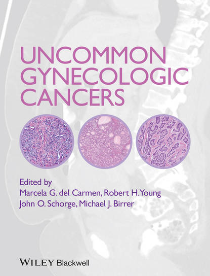 Uncommon Gynecologic Cancers - Группа авторов