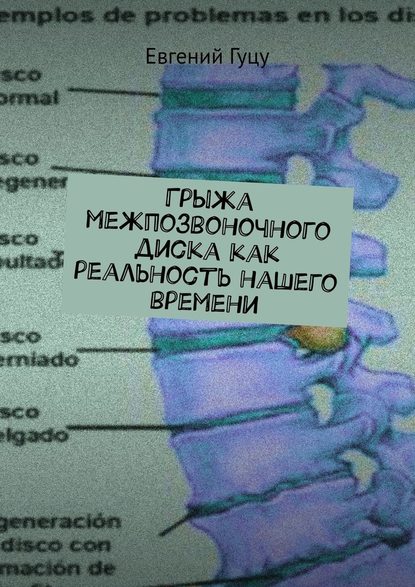 Грыжа межпозвоночного диска как реальность нашего времени — Евгений Валерьевич Гуцу