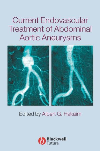 Current Endovascular Treatment of Abdominal Aortic Aneurysms — Группа авторов