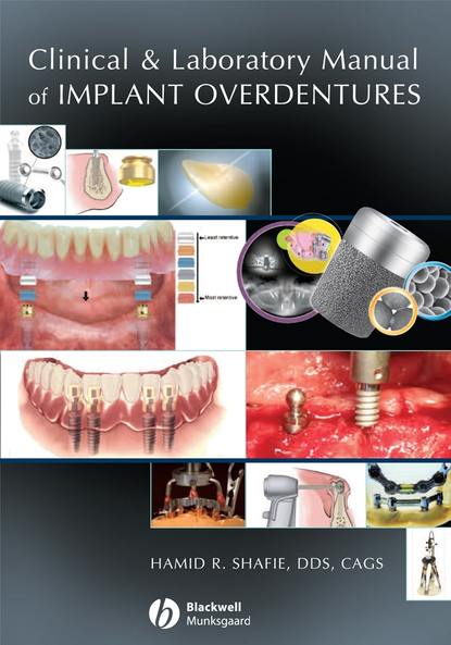 Clinical and Laboratory Manual of Implant Overdentures — Группа авторов