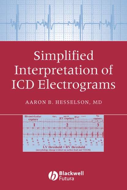 Simplified Interpretation of ICD Electrograms — Группа авторов